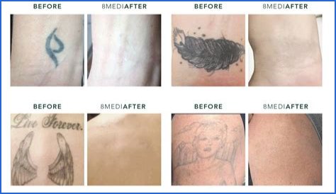 Sappho Tattoo Removal: Is the Trend Dying Out?